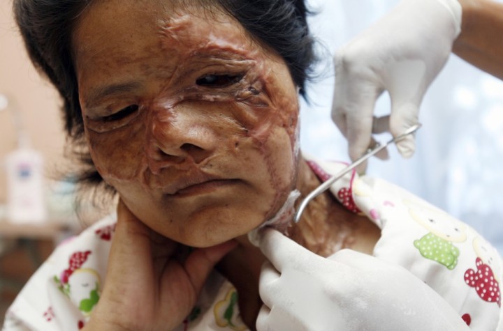 victim-acid-attack-receives-treatment-cambodia-acid-survivors-charity-kandal-province-west