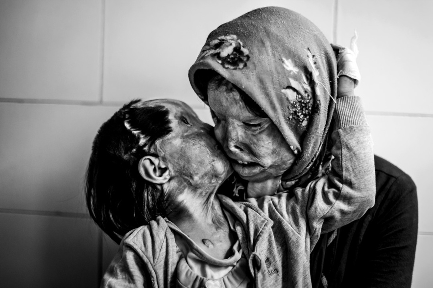 36. A mother is comforted by her 3 year old daughter they were both attacked with acid by their husband father